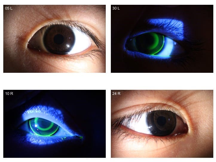 Optometrist performing contact lens fitting