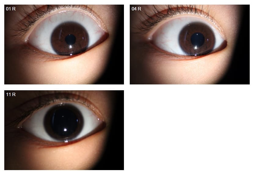 Cycloplegic Eyedrops